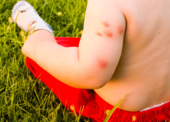 Mosquito Allergy Symptoms - Understanding and Managing Reactions