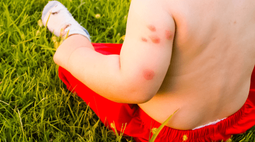 Mosquito Allergy Symptoms – Understanding and Managing Reactions