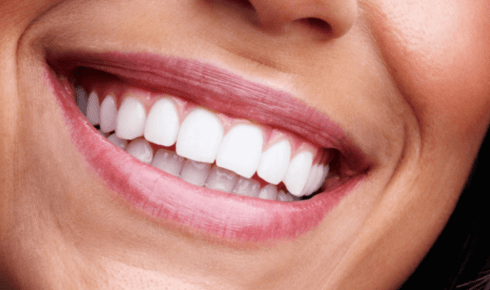 full mouth dental reconstruction