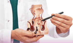 thrombosed hemorrhoid treatment