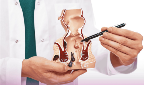 thrombosed hemorrhoid treatment