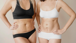 best mommy makeover in bangalore